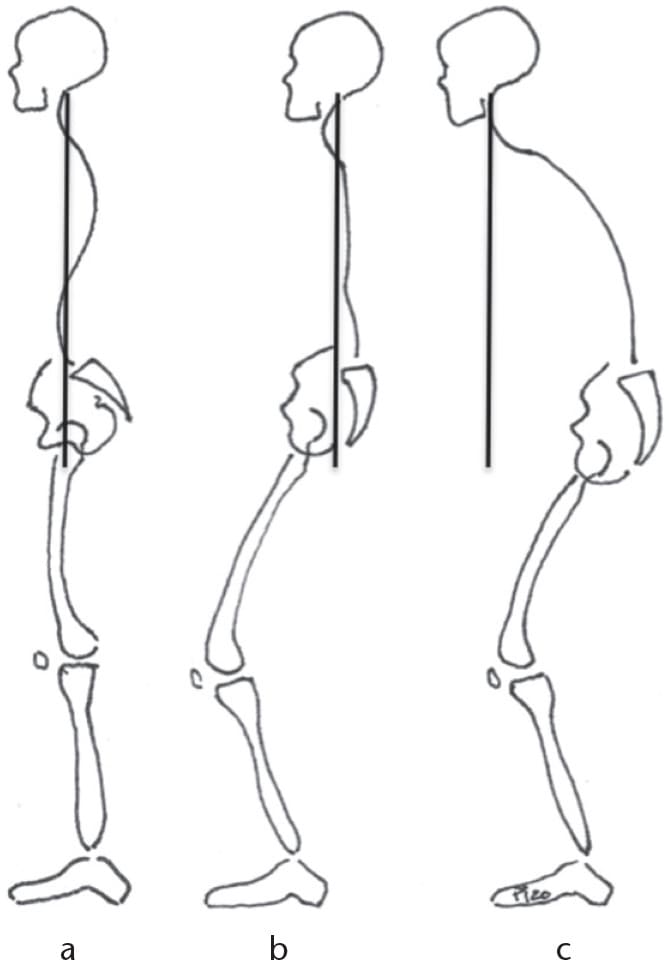 alineacion columna pelvis